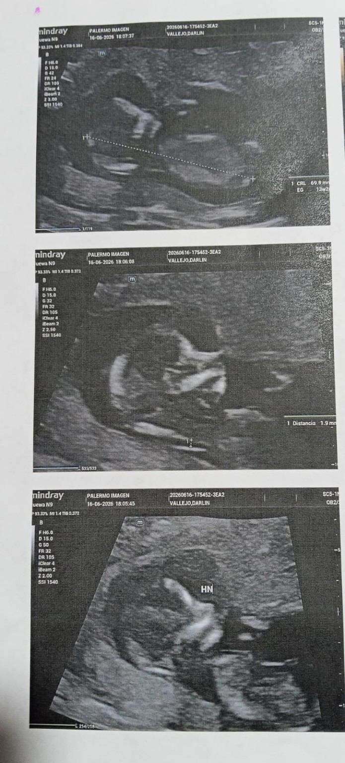 Ecografía de 13 semanas de Gael